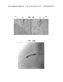 AUTOMATIC ANGIOGRAM DETECTION diagram and image