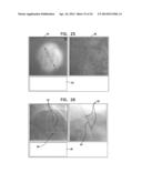 AUTOMATIC ANGIOGRAM DETECTION diagram and image