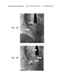 AUTOMATIC ANGIOGRAM DETECTION diagram and image