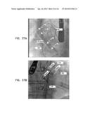 AUTOMATIC ANGIOGRAM DETECTION diagram and image