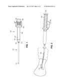 BIOPSY DEVICE WITH AUTOMATIC ASPIRATION diagram and image