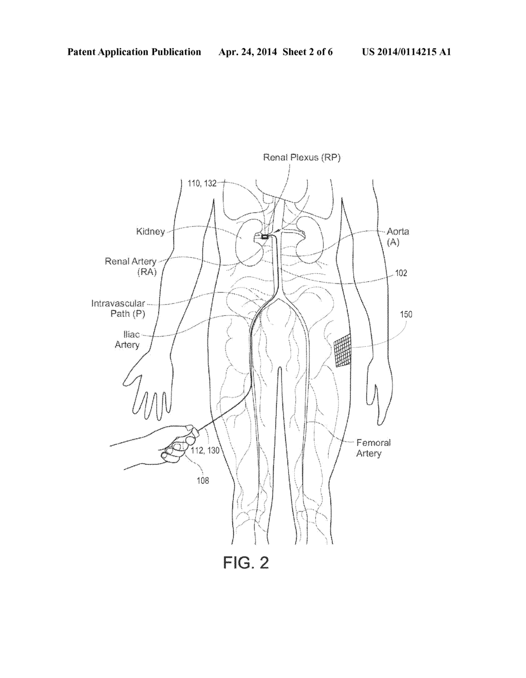 Methods for Renal Neuromodulation and Associated Systems and Devices - diagram, schematic, and image 03