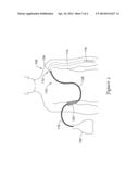 LYMPHEDEMA MEDICAL DEVICE diagram and image