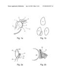 ARTHROSCOPIC BONE TRANSPLANTING PROCEDURE, AND MEDICAL INSTRUMENTS USEFUL     THEREIN diagram and image