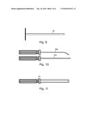 ARTHROSCOPIC BONE TRANSPLANTING PROCEDURE, AND MEDICAL INSTRUMENTS USEFUL     THEREIN diagram and image