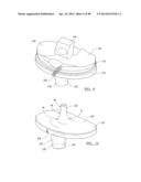 KNEE JOINT PROSTHESIS SYSTEM AND METHOD FOR IMPLANTATION diagram and image