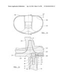 KNEE JOINT PROSTHESIS SYSTEM AND METHOD FOR IMPLANTATION diagram and image