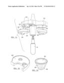 KNEE JOINT PROSTHESIS SYSTEM AND METHOD FOR IMPLANTATION diagram and image