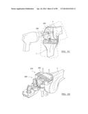 KNEE JOINT PROSTHESIS SYSTEM AND METHOD FOR IMPLANTATION diagram and image