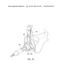 KNEE JOINT PROSTHESIS SYSTEM AND METHOD FOR IMPLANTATION diagram and image