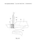 KNEE JOINT PROSTHESIS SYSTEM AND METHOD FOR IMPLANTATION diagram and image