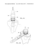 KNEE JOINT PROSTHESIS SYSTEM AND METHOD FOR IMPLANTATION diagram and image