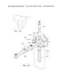 KNEE JOINT PROSTHESIS SYSTEM AND METHOD FOR IMPLANTATION diagram and image