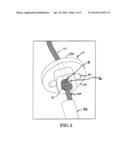 ADJUSTABLE SUTURE RESTRICTION SYSTEM AND METHOD diagram and image