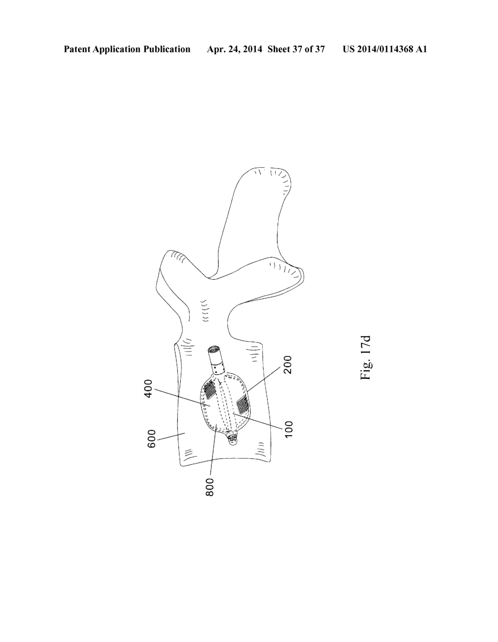 DEVICE FOR BONE FIXATION - diagram, schematic, and image 38