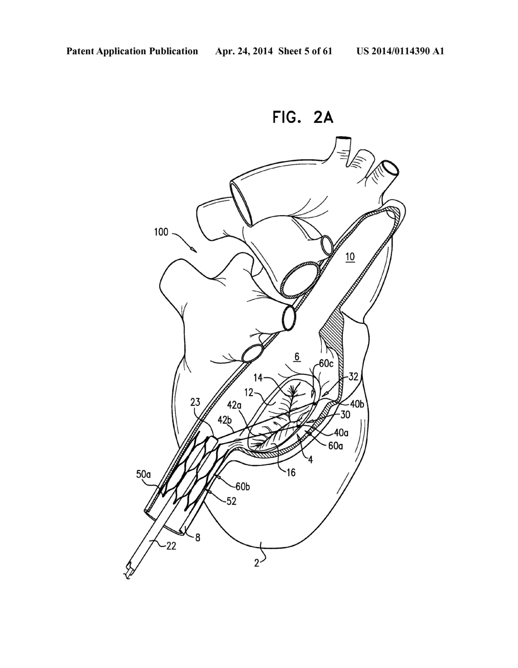 TRICUSPID VALVE REPAIR USING TENSION - diagram, schematic, and image 06