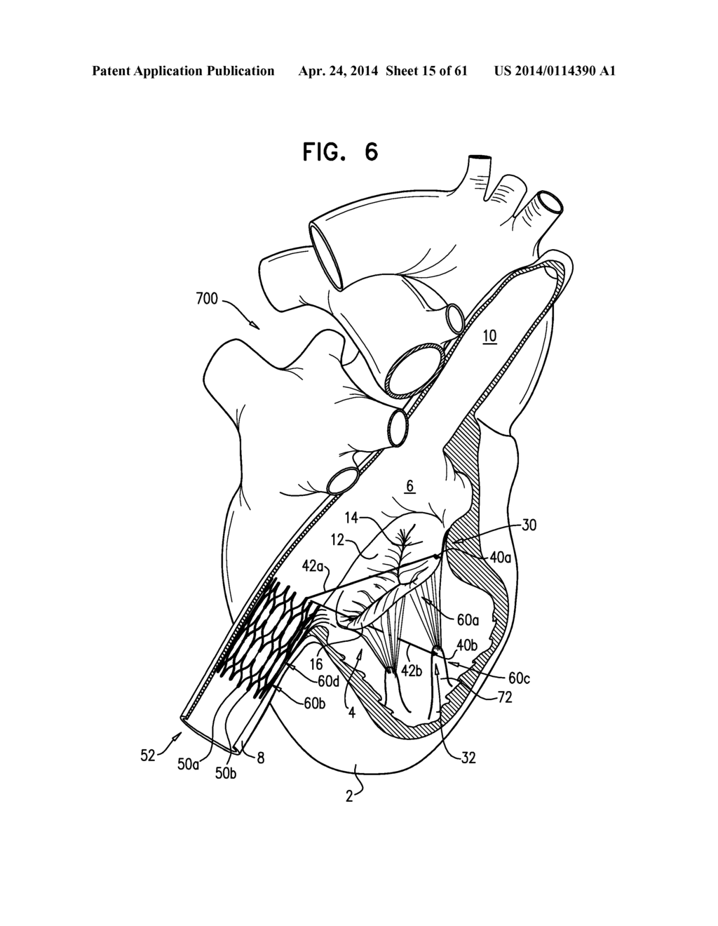 TRICUSPID VALVE REPAIR USING TENSION - diagram, schematic, and image 16