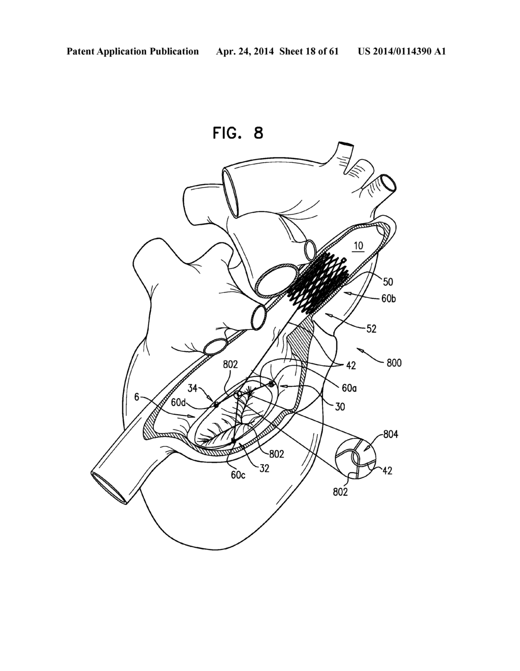 TRICUSPID VALVE REPAIR USING TENSION - diagram, schematic, and image 19