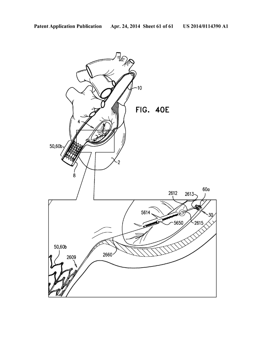 TRICUSPID VALVE REPAIR USING TENSION - diagram, schematic, and image 62