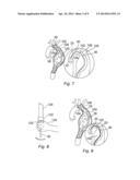 METHOD AND APPARATUS FOR CONTROLLING THE DEPLOYMENT OF A STENT diagram and image