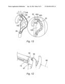 METHOD AND APPARATUS FOR CONTROLLING THE DEPLOYMENT OF A STENT diagram and image