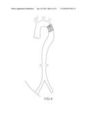 Percutaneously Implantable Replacement Heart Valve Device and Method of     Making Same diagram and image