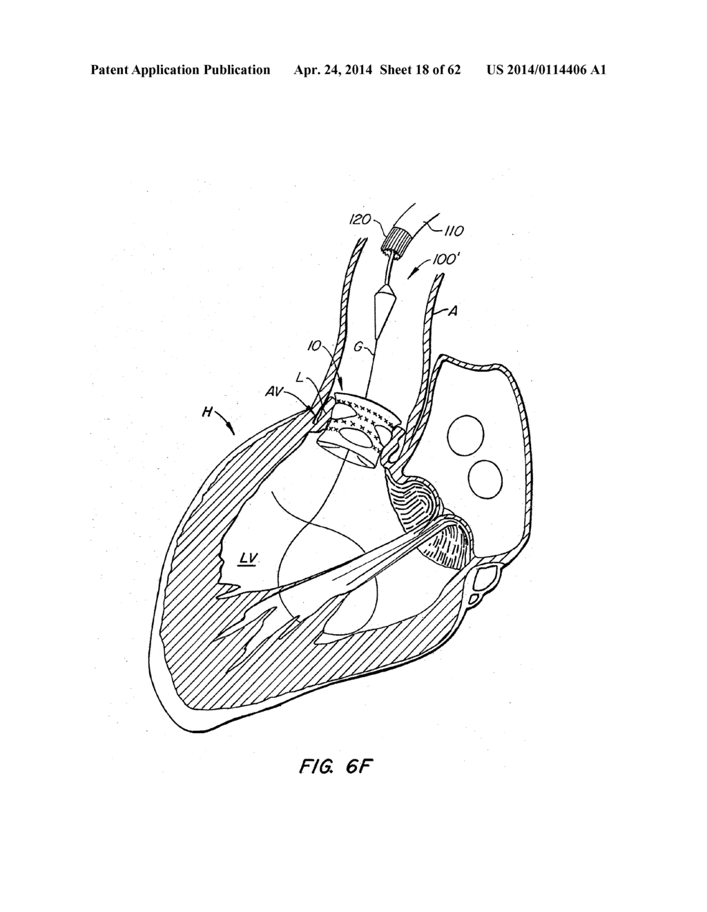 LOW PROFILE HEART VALVE AND DELIVERY SYSTEM - diagram, schematic, and image 19