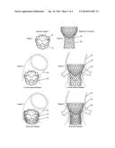 METHODS FOR INHIBITING STENOSIS, OBSTRUCTION, OR CALCIFICATION OF A     STENTED HEART VALVE diagram and image