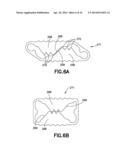 PLASTICALLY DEFORMABLE INTER-OSSEOUS DEVICE diagram and image