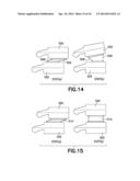 PLASTICALLY DEFORMABLE INTER-OSSEOUS DEVICE diagram and image