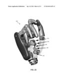 HAND PROSTHESIS diagram and image