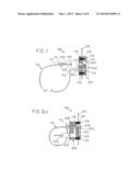 CLOSURE DEVICE FOR SECURING OBJECTS CONTAINED INSIDE A BODY diagram and image