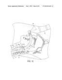 Self-Pressurizing Supraglottic Airway diagram and image