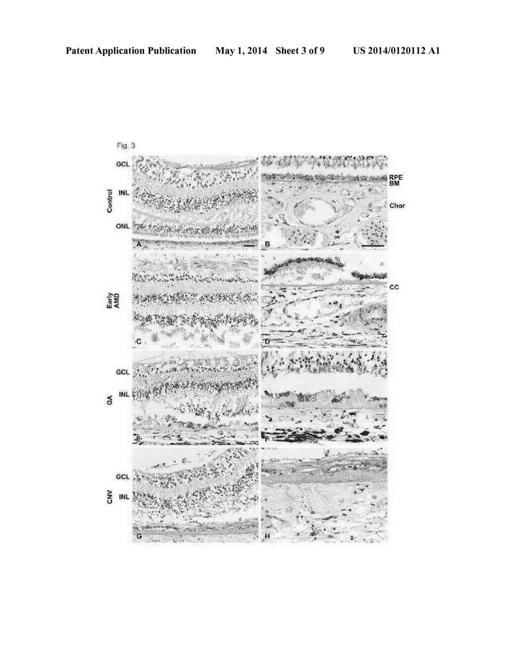 THERAPEUTICS FOR AGE-RELATED MACULAR DEGENERATION - diagram, schematic, and image 04