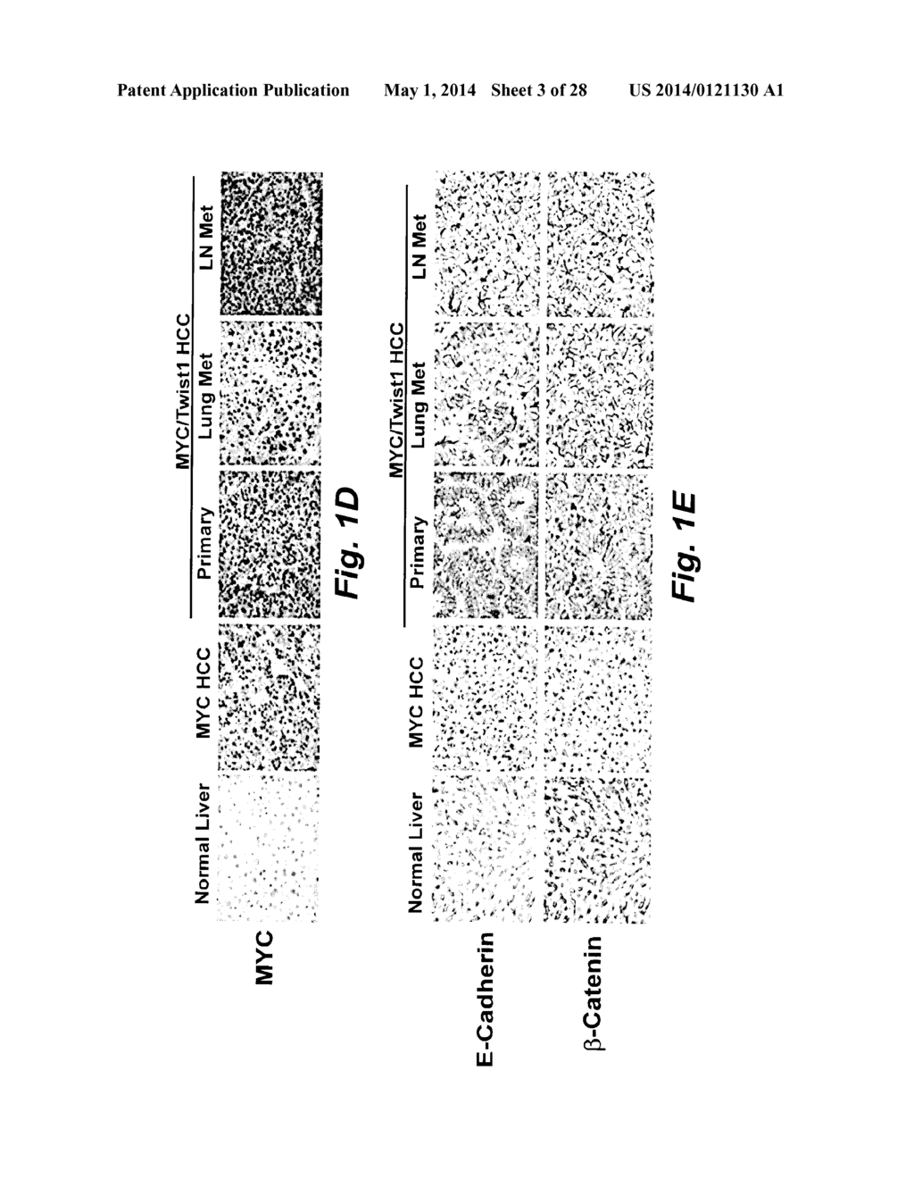 METHOD OF DETERMINING THE PROGNOSIS OF HEPATOCELLULAR CARCINOMAS USING A     MULTIGENE SIGNATURE ASSOCIATED WITH METASTASIS - diagram, schematic, and image 04