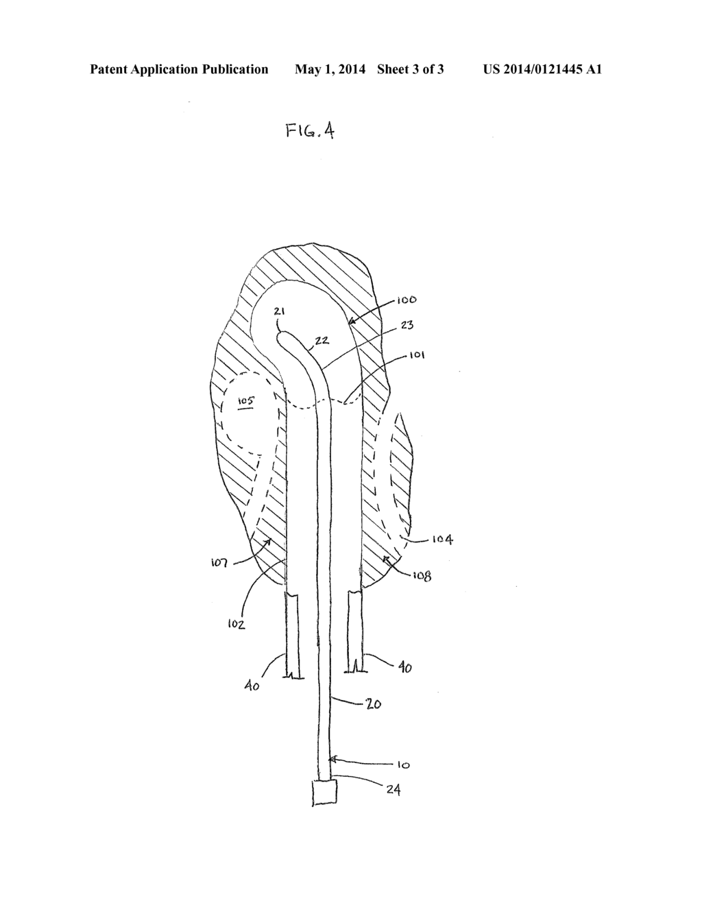 Intracavitary Brachytherapy Device for Insertion in a Body Cavity and     Methods of Use Thereof - diagram, schematic, and image 04