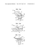 Abutment Attachment Systems, Mechanisms, Devices, Components and Methods     for Bone Conduction Hearing Aids diagram and image