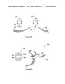 SYSTEMS, METHODS AND DEVICES RELATING TO IMPLANTABLE SUPPORTIVE SLINGS diagram and image