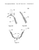 SYSTEMS, METHODS AND DEVICES RELATING TO IMPLANTABLE SUPPORTIVE SLINGS diagram and image