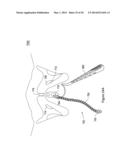 SYSTEMS, METHODS AND DEVICES RELATING TO IMPLANTABLE SUPPORTIVE SLINGS diagram and image