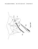 SYSTEMS, METHODS AND DEVICES RELATING TO IMPLANTABLE SUPPORTIVE SLINGS diagram and image