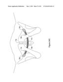 SYSTEMS, METHODS AND DEVICES RELATING TO IMPLANTABLE SUPPORTIVE SLINGS diagram and image