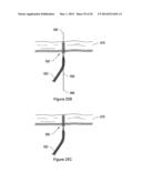 SYSTEMS, METHODS AND DEVICES RELATING TO IMPLANTABLE SUPPORTIVE SLINGS diagram and image