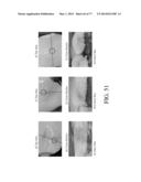 INJECTION NEEDLE AND DEVICE diagram and image