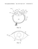 Ophthalmic System for Sustained Release of Drug to Eye diagram and image