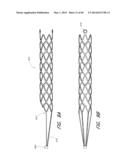 REVASCULARIZATION DEVICES diagram and image