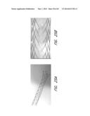 REVASCULARIZATION DEVICES diagram and image