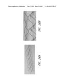 REVASCULARIZATION DEVICES diagram and image