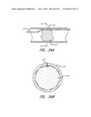 REVASCULARIZATION DEVICES diagram and image