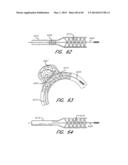 REVASCULARIZATION DEVICES diagram and image